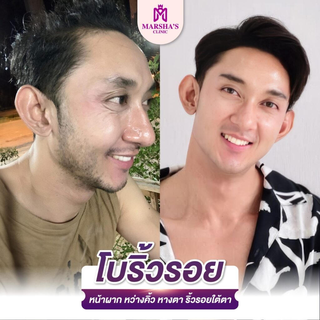 โบลดริ้วรอย