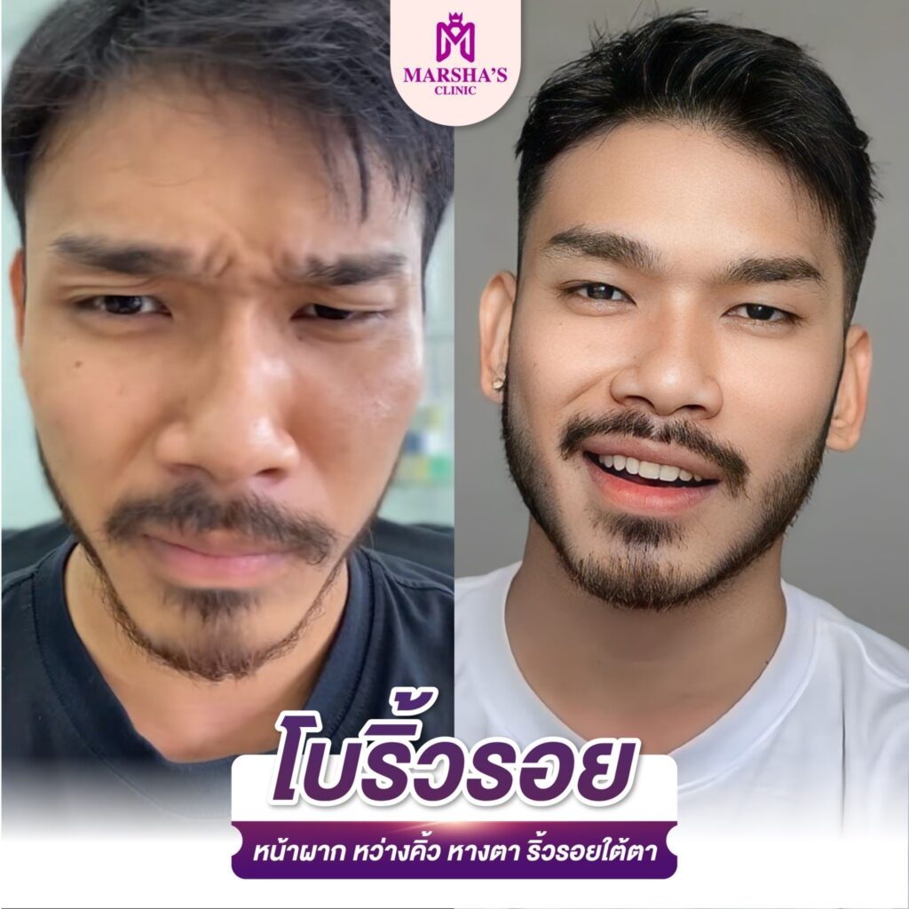 โบลดริ้วรอย