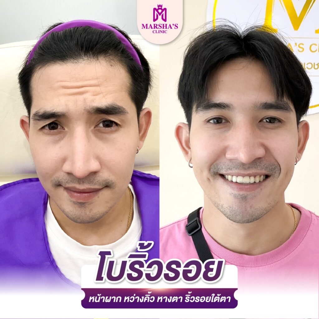 โบลดริ้วรอย