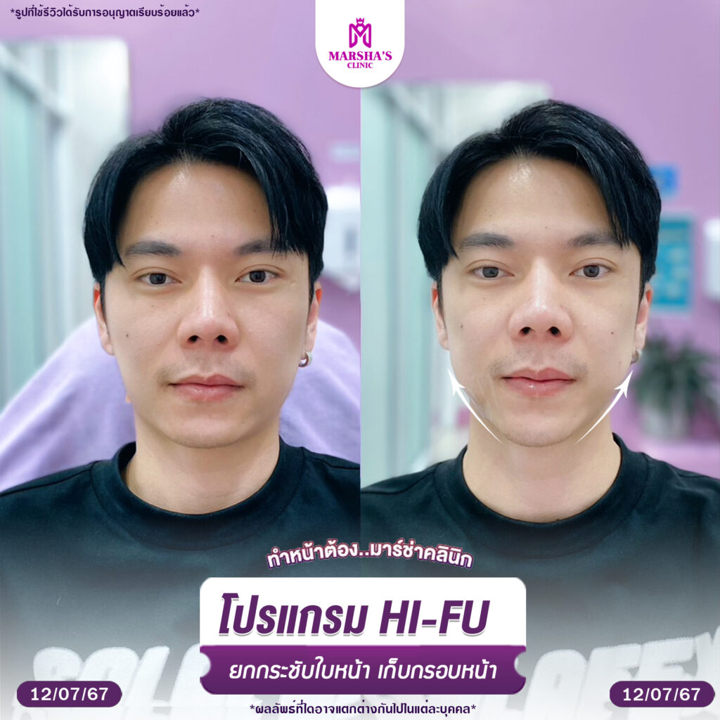โปรแกรม Hifu