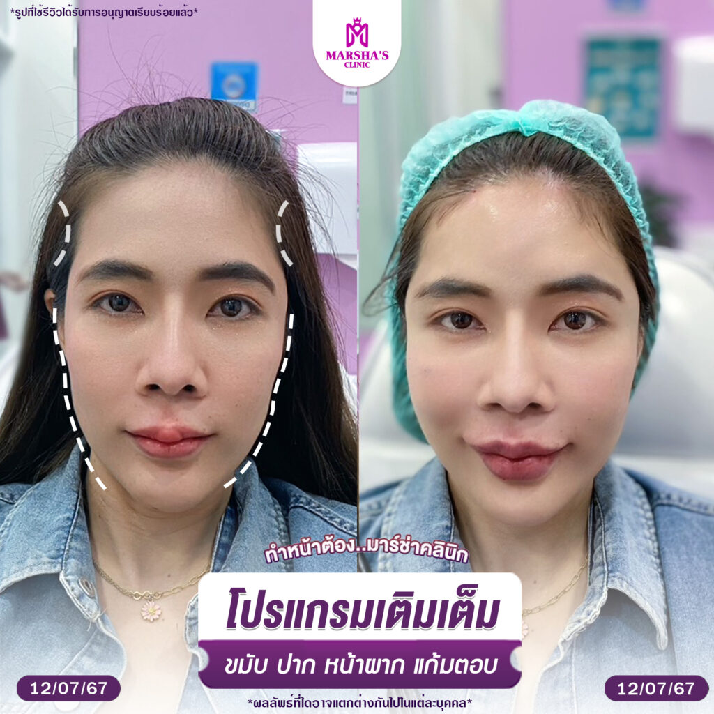 โปรแกรมเติมเต็ม