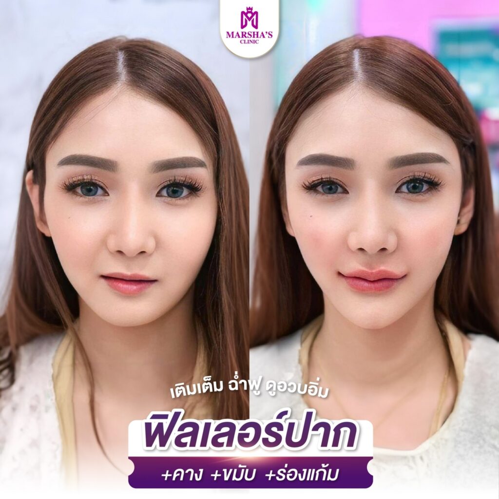 LINE_ALBUM_R ฟิลเลอร์ ปาก_๒๔๐๓๑๙_8