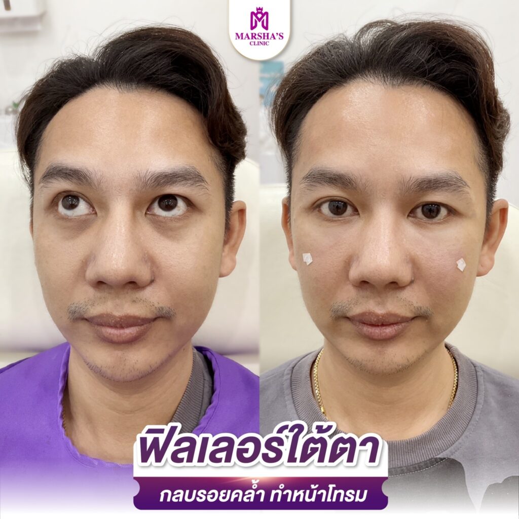 LINE_ALBUM_R ใต้ตา_๒๔๐๓๑๙_4
