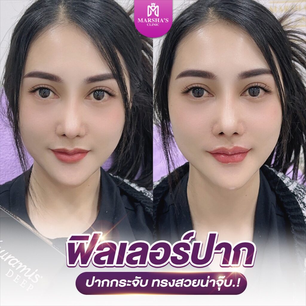 LINE_ALBUM_รีวิวฟิลเลอร์ 1_๒๔๐๒๐๕_5