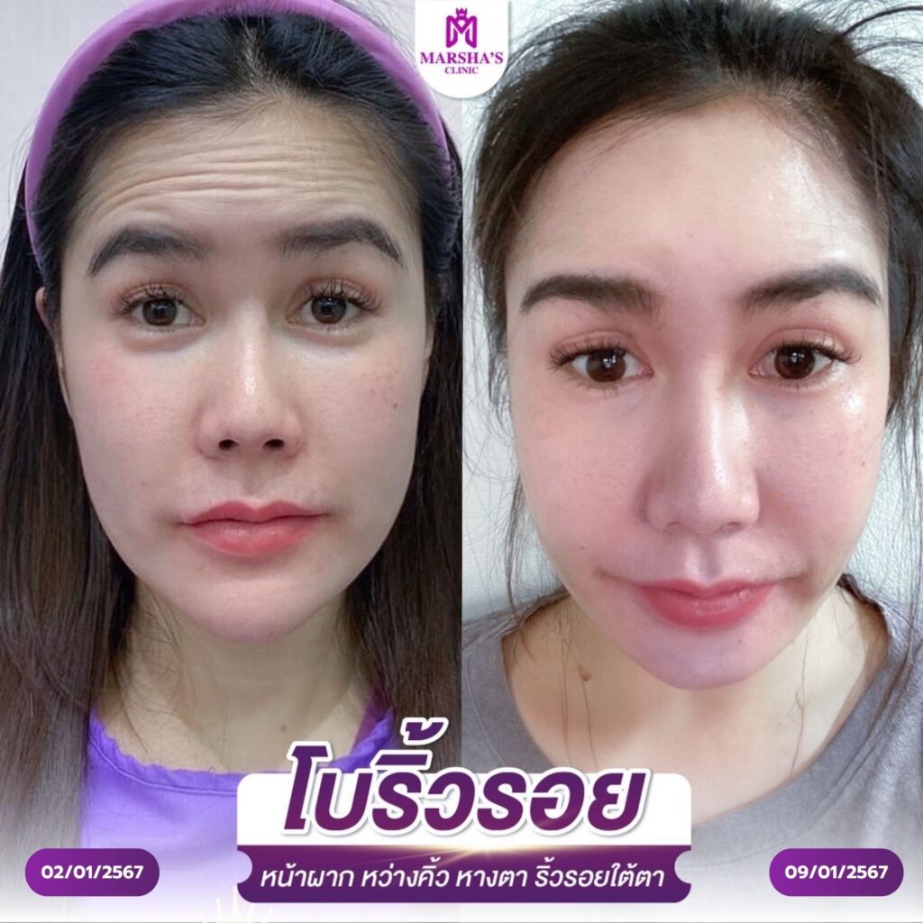 โบลดริ้วรอย