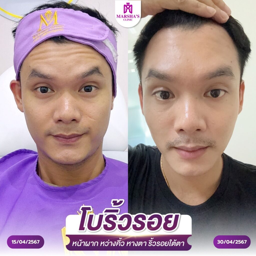 โบลดริ้วรอย