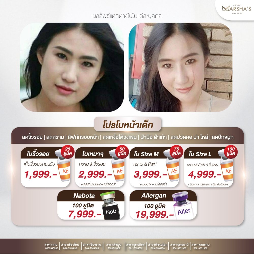 ลดริ้วรอย หน้าเล็กเรียว